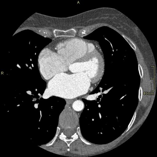 Chronic pulmonary embolism (Radiopaedia 73073-85094 Axial C+ CTPA 91).jpg