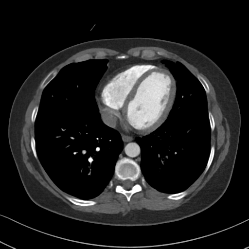 File:Chronic pulmonary embolus (Radiopaedia 39129-41341 Axial C+ CTPA 71).png