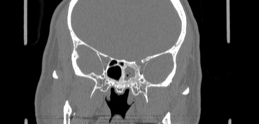 File:Chronic sphenoidal sinusitis (Radiopaedia 62030-70122 Coronal bone window 109).jpg