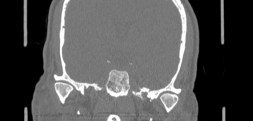 Chronic sphenoidal sinusitis (Radiopaedia 62030-70122 Coronal bone window 145).jpg
