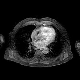 Cirrhosis and hepatocellular carcinoma in the setting of hemochromatosis (Radiopaedia 75394-86594 Axial T1 C+ fat sat 348).jpg