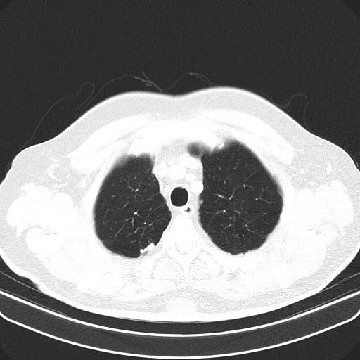 File:Classic complicated silicosis (Radiopaedia 49720-54961 Axial lung window 8).jpg
