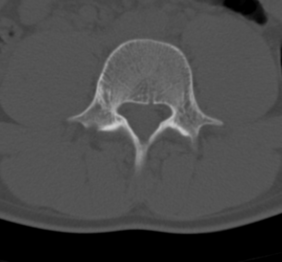 Clear cell meningoma - lumbar spine (Radiopaedia 60116-67691 Axial bone window 49).png