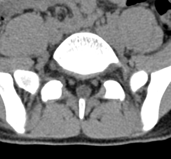File:Clear cell meningoma - lumbar spine (Radiopaedia 60116-67691 Axial non-contrast 64).png