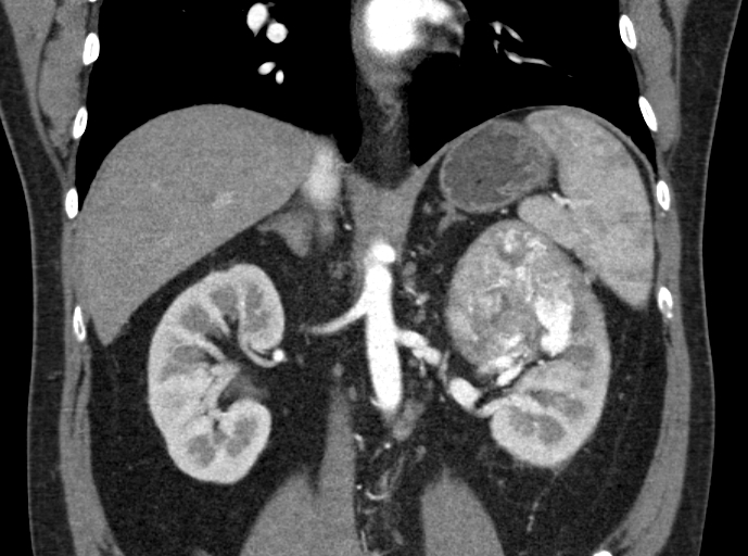 File:Clear cell renal cell carcinoma (Radiopaedia 61449-69393 C 22).jpg