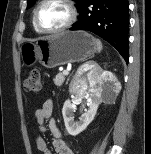 File:Clear cell renal cell carcinoma (Radiopaedia 61449-69393 D 27).jpg
