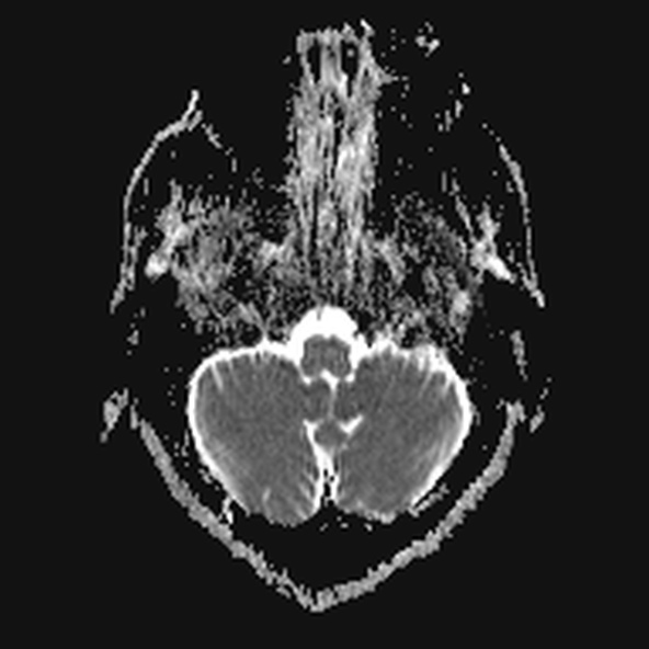 File:Clival meningioma (Radiopaedia 53278-59248 Axial ADC 3).jpg