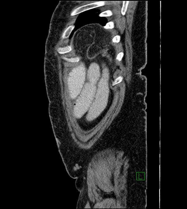 Closed-loop small bowel obstruction-internal hernia (Radiopaedia 78439-91096 C 23).jpg
