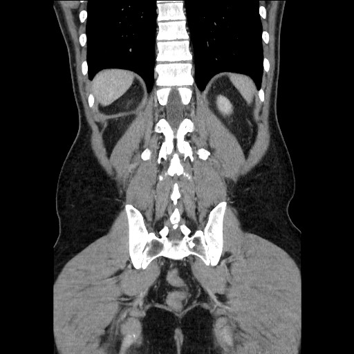 Closed-loop small bowel obstruction (Radiopaedia 73713-84509 C 98).jpg