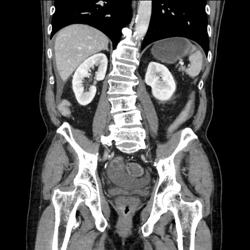 Closed loop obstruction due to adhesive band, resulting in small bowel ischemia and resection (Radiopaedia 83835-99023 E 85).jpg