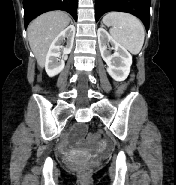 Closed loop small bowel obstruction (Radiopaedia 71211-81508 B 89).jpg