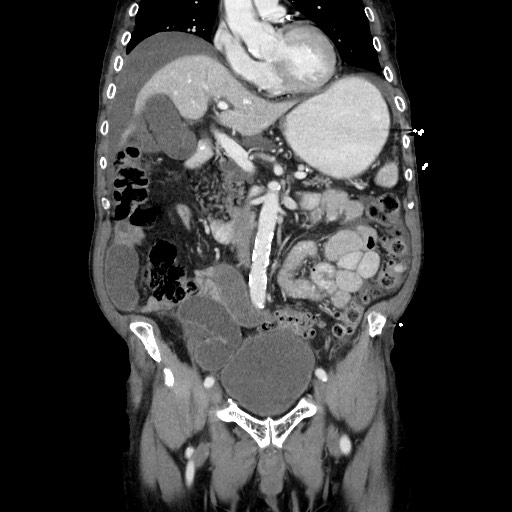 Closed loop small bowel obstruction - adhesive disease and hemorrhagic ischemia (Radiopaedia 86831-102990 B 58).jpg