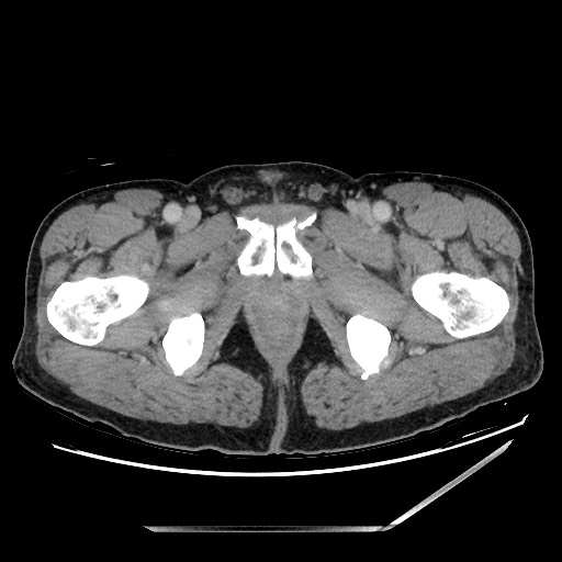 Closed loop small bowel obstruction - omental adhesion causing "internal hernia" (Radiopaedia 85129-100682 A 176).jpg