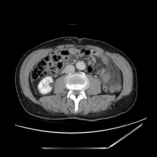 File:Closed loop small bowel obstruction - omental adhesion causing "internal hernia" (Radiopaedia 85129-100682 A 88).jpg