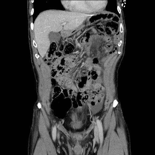 File:Closed loop small bowel obstruction - omental adhesion causing "internal hernia" (Radiopaedia 85129-100682 B 44).jpg
