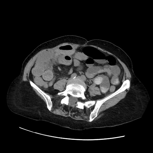 File:Closed loop small bowel obstruction due to adhesive band, with intramural hemorrhage and ischemia (Radiopaedia 83831-99017 Axial 196).jpg