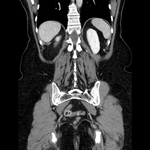 File:Closed loop small bowel obstruction due to adhesive bands - early and late images (Radiopaedia 83830-99015 B 96).jpg