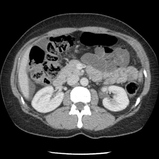 File:Closed loop small bowel obstruction due to trans-omental herniation (Radiopaedia 35593-37109 A 36).jpg
