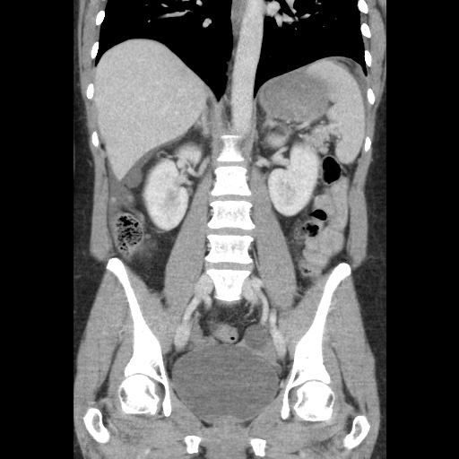 File:Closed loop small bowel obstruction due to trans-omental herniation (Radiopaedia 35593-37109 B 33).jpg