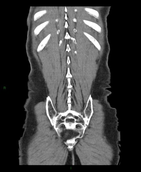 File:Closed loop small bowel obstruction with ischemia (Radiopaedia 84180-99456 B 5).jpg