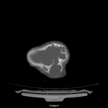Cloverleaf skull (Radiopaedia 91901-109710 Axial bone window 134).jpg