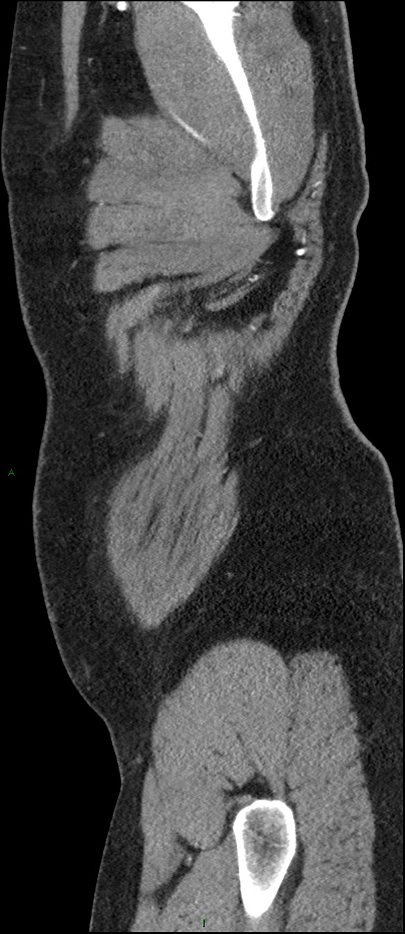 Coarctation of the aorta (Radiopaedia 74632-88521 C 317).jpg