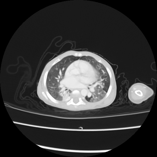 Coarctation of the aorta and patent ductus arteriosus (Radiopaedia 68033-77499 Axial lung window 27).jpg