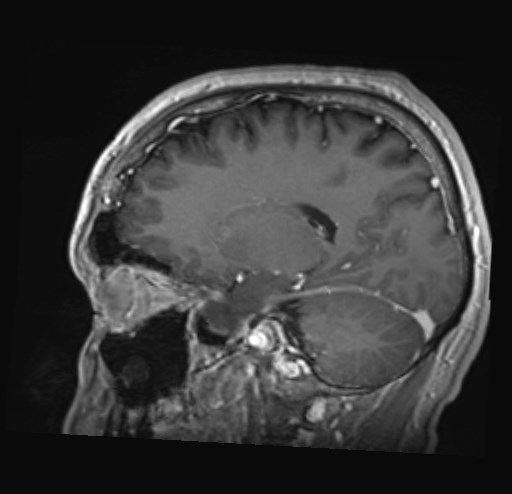 Cochlear incomplete partition type III associated with hypothalamic hamartoma (Radiopaedia 88756-105498 Sagittal T1 C+ 34).jpg