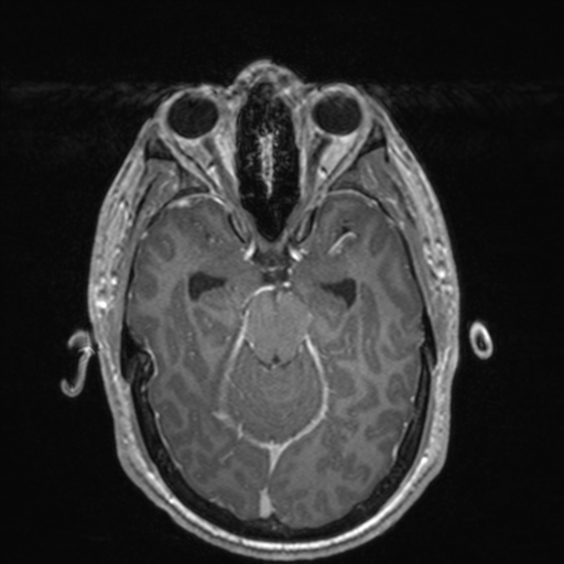 File:Colloid cyst (Radiopaedia 44510-48181 Axial T1 C+ 71).png