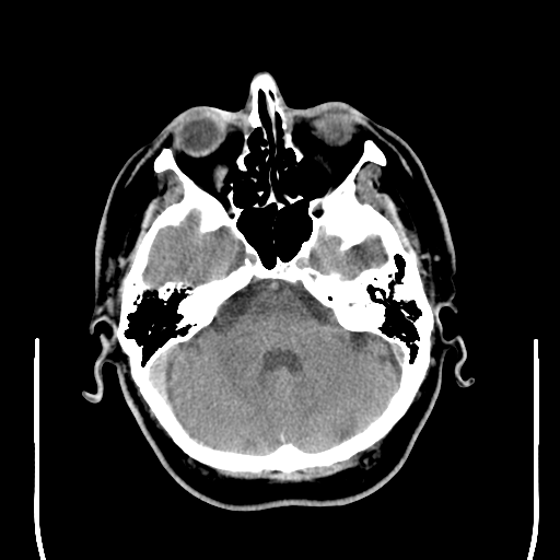 File:Colloid cyst (large) (Radiopaedia 34415-35734 Axial non-contrast 17).png