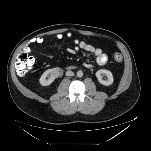 Colocolic intussusception due to lipoma (Radiopaedia 73712-84508 A 59).jpg