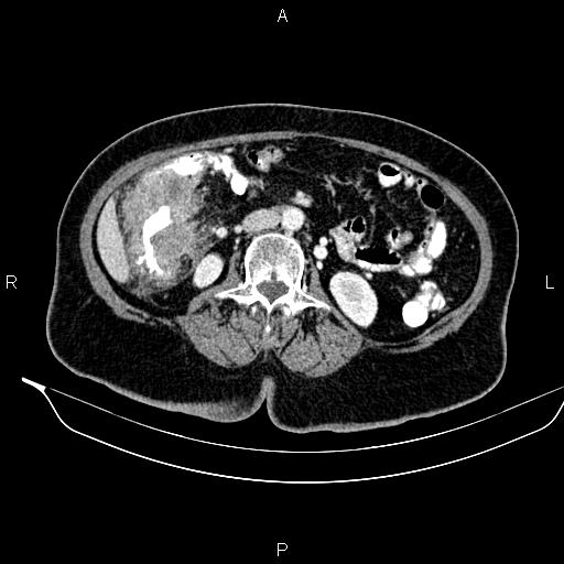 Colon adenocarcinoma (Radiopaedia 91240-108842 A 43).jpg