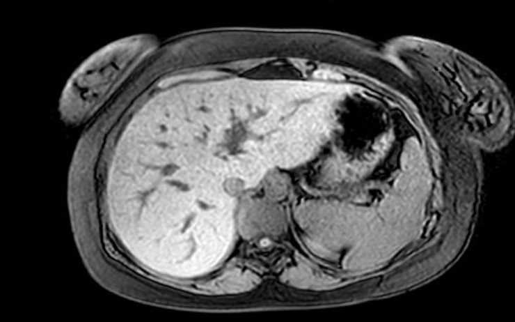Colon adenocarcinoma with Krukenberg tumors, advanced pregnancy (Radiopaedia 67279-76645 A 67).jpg