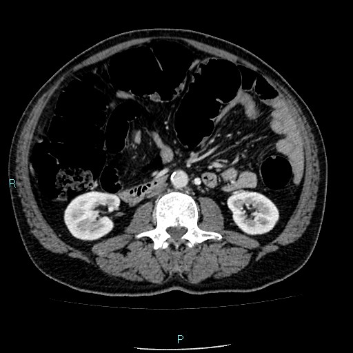 Colon adenocarcinoma with calcific liver metastasis (Radiopaedia 55745-62300 B 21).jpg