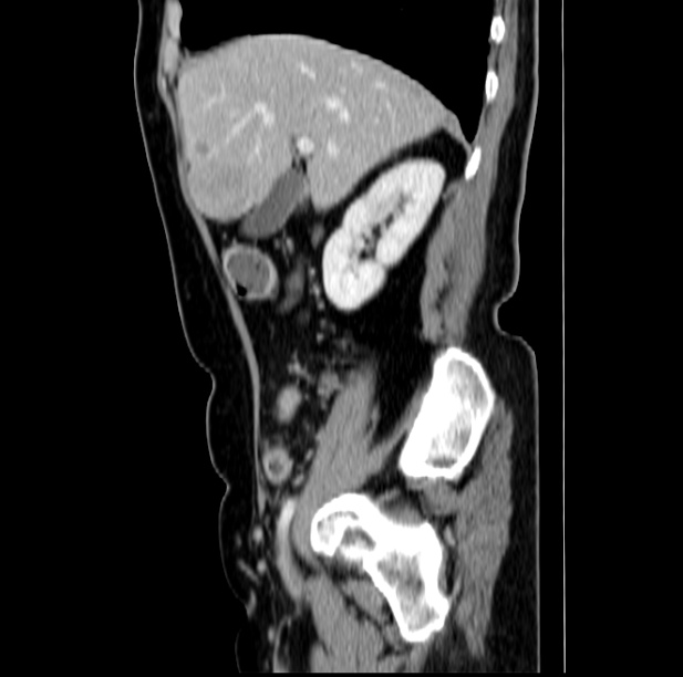 Colon carcinoma with hepatic metastases (Radiopaedia 29477-29961 C 17).jpg
