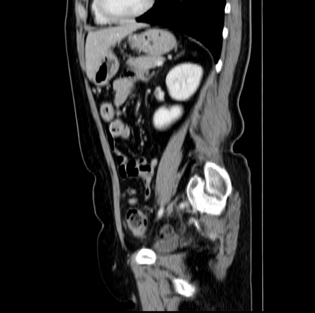Colon carcinoma with hepatic metastases (Radiopaedia 29477-29961 C 37).jpg