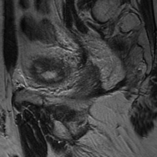 File:Colonic fistula (Radiopaedia 16047-15708 Sagittal T2 1).jpg