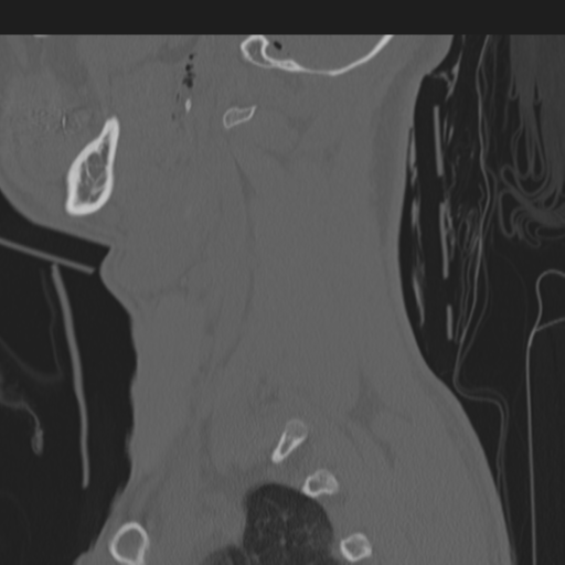 File:Multitrauma with diffuse axonal injury, temporal bone fractures and traumatic caroticocavernous fistula (Radiopaedia 37242-39035 Sagittal 51).png