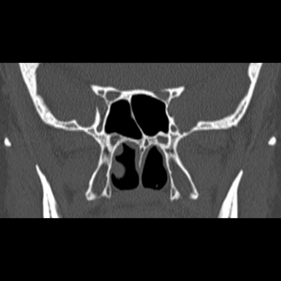 Nasal septal perforation (Radiopaedia 25030-25289 Coronal bone window 53).jpg
