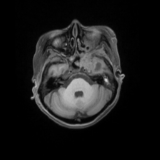 File:Nasopharyngeal carcinoma with cerebral abscess (Radiopaedia 43018-46274 Axial T1 fat sat 16).png