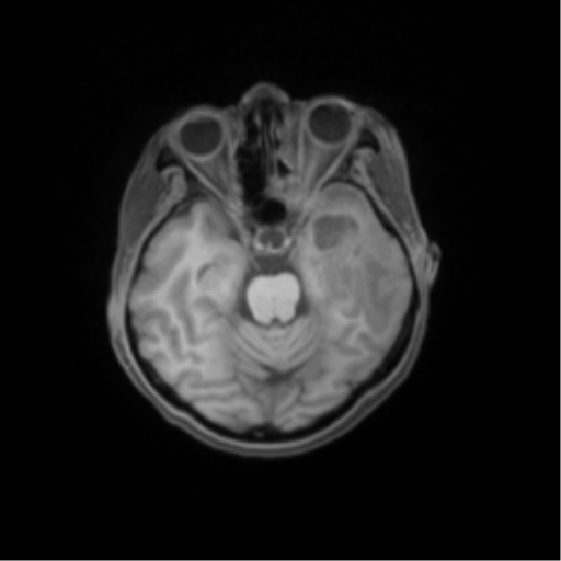 File:Nasopharyngeal carcinoma with cerebral abscess (Radiopaedia 43018-46274 Axial T1 fat sat 20).png