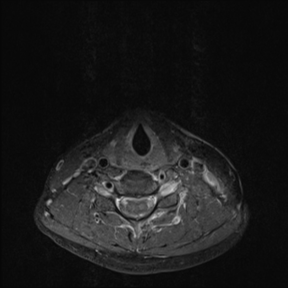 File:Nasopharyngeal carcinoma with skull base invasion (Radiopaedia 53415-59485 Axial T1 C+ fat sat 59).jpg