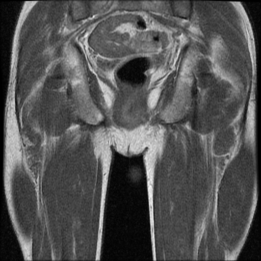 File:Necrotizing epididymo-orchitis with intra-testicular abscess (Radiopaedia 29397-29860 Coronal T1 C+ 19).jpg