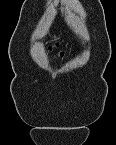 File:Nephrostomy for urosepsis (Radiopaedia 26180-26330 non-contrast 11).jpg