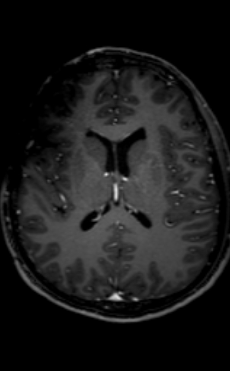 Neuro-Behçet disease (Radiopaedia 90112-107294 Axial T1 C+ 116).jpg