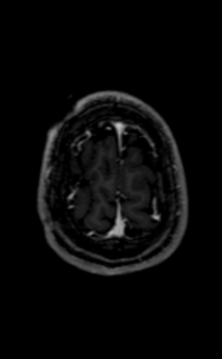 Neuro-Behçet disease (Radiopaedia 90112-107294 Axial T1 C+ 61).jpg