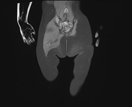 File:Neuroblastoma with bone metastases (Radiopaedia 67080-76414 E 23).jpg