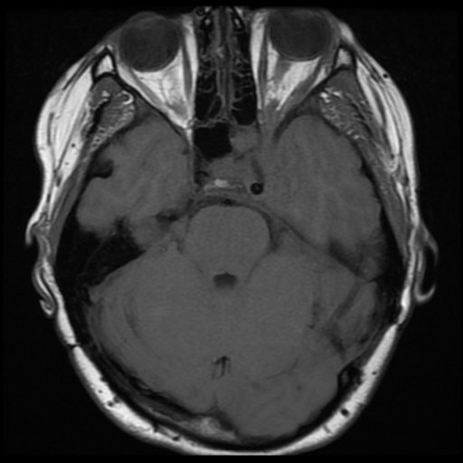 File:Neurofibromatosis type 2 (Radiopaedia 45229-49251 Axial T1 12).png
