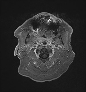 Neurofibromatosis type 2 (Radiopaedia 79097-92049 Axial T1 C+ 11).jpg