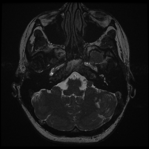 File:Neurofibromatosis type 2 - bilateral acoustic neuromata (Radiopaedia 40060-42566 Axial FIESTA 26).png